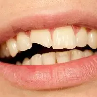 چرا دندان‌ها زود به زود پوسیده می‌شوند؟