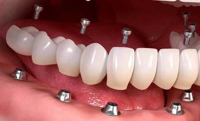 طول عمر دندان ایمپلنت شده چقدر است؟