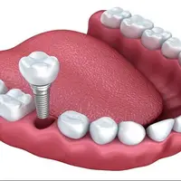 چه زمانی باید دندان را ایمپلنت کنیم؟ 
