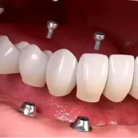 طول عمر دندان ایمپلنت شده چقدر است؟