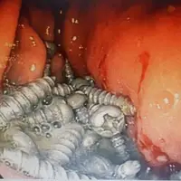 خارج کردن ۴۷ پیچ از معده یک بیمار