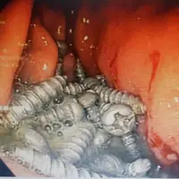 خارج کردن ۴۷ پیچ فلزی از معده یک بیمار در کرج