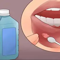 روش درمان آفت شدید دهان