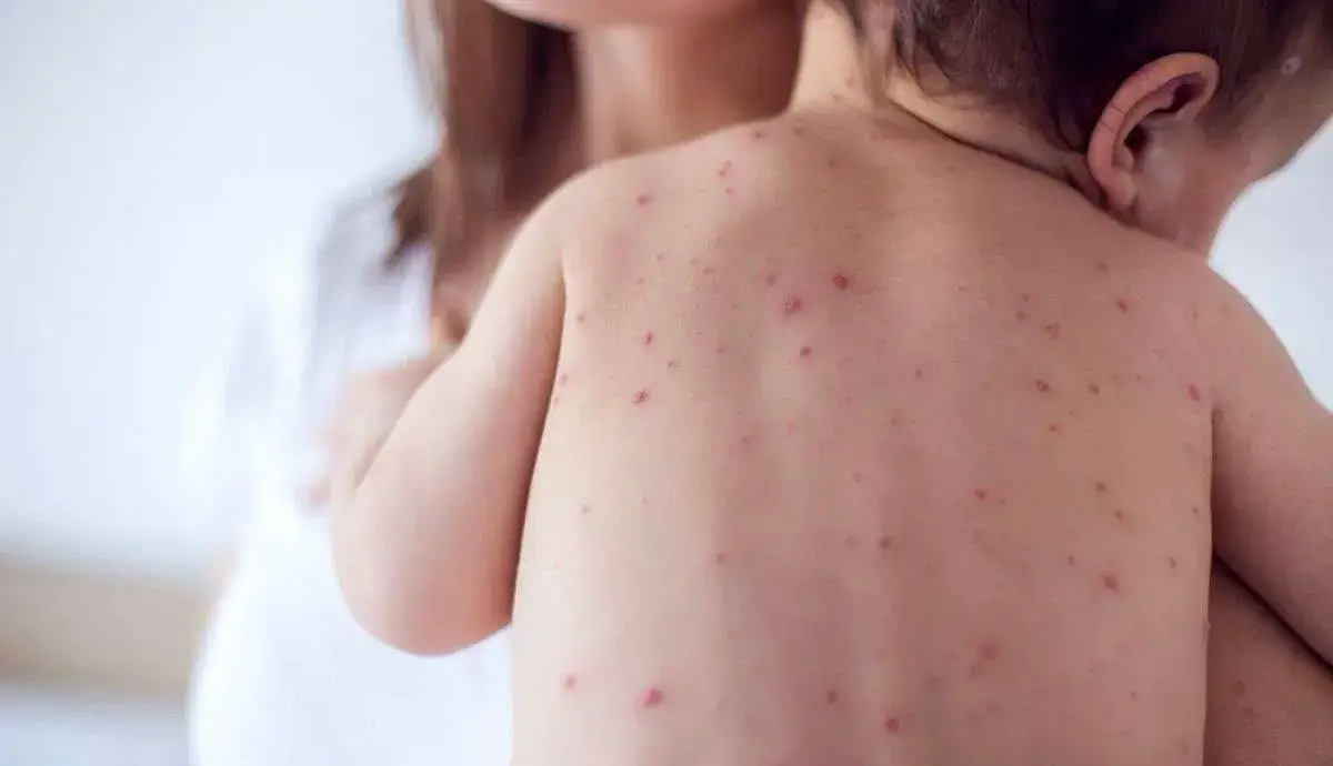 زنگ خطر شیوع مجدد سرخک به صدا درآمد