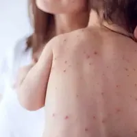 زنگ خطر شیوع مجدد سرخک به صدا درآمد