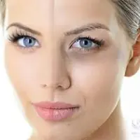 رفع دائمی سیاهی زیر چشم!