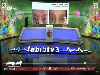 آیا بوتاکس می‌تواند جایگزینی برای بلفاروپلاستی باشد؟