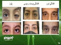 افتادگی ابرو چیست ؟
