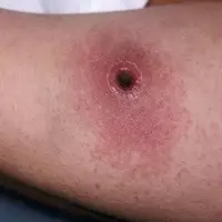 شناسایی 2 مورد ابتلا به بیماری سیاه‌زخم در بویراحمد