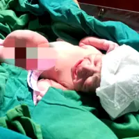 جگرگوشه پیوند کبد گیلان متولد شد