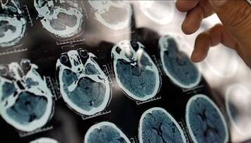 عوامل مؤثر در پیشگیری از آلزایمر