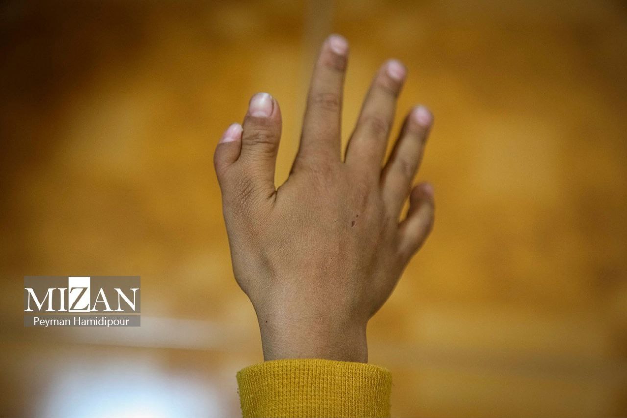 عکس/ پزشکان و متخصصان پای کار جراحی رایگان کودکان با ناهنجاری‌های مادرزادی