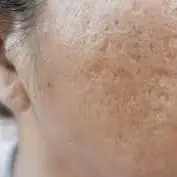 با این ماسک جای جوشاتو درمان کن!