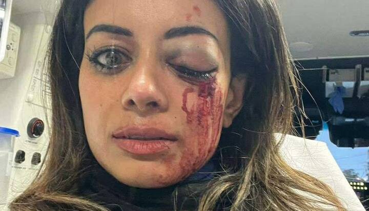 مجروحیت شدید سیاستمدار حامی فلسطین از ناحیه چشم دراعتراضات سیدنی