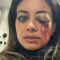 مجروحیت شدید سیاستمدار حامی فلسطین از ناحیه چشم دراعتراضات سیدنی