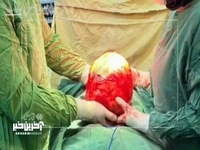 خارج کردن توده ۱۱ کیلویی از شکم بیماری در آمل