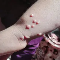 فراگیری نوعی بیماری پوستی در یکی از روستاهای بوکان
