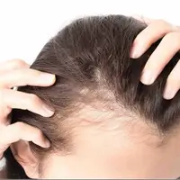 ویتامینی که کمبود آن سبب ریزش مو می‌شود