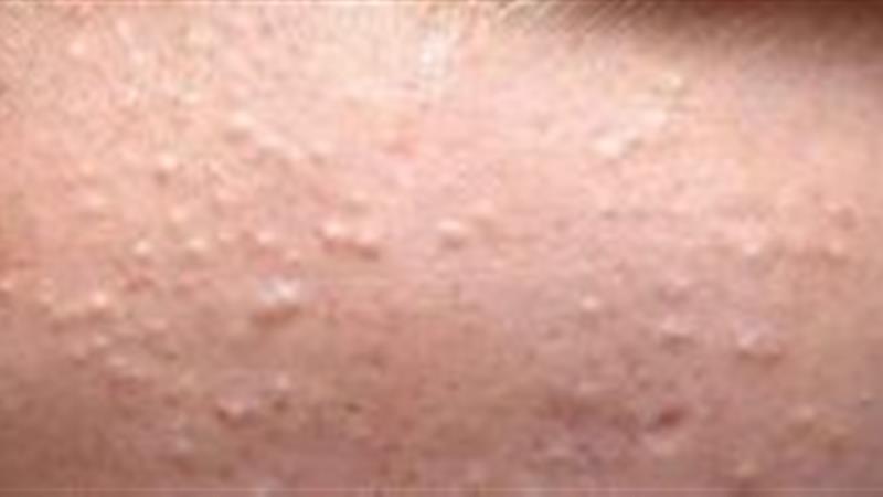 چگونه جوشهای زیر پوستی را درمان کنیم ؟