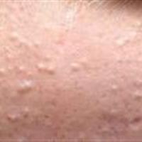 چگونه  جوش‌های زیر پوستی  را درمان کنیم ؟