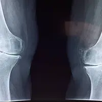 تشخیص علائم اولیه پوکی استخوان با هوش مصنوعی