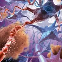 چرا مبتلایان به سندروم داون زودتر آلزایمر می‌گیرند؟