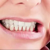 این خوراکی‌ها قاتل دندان هستند