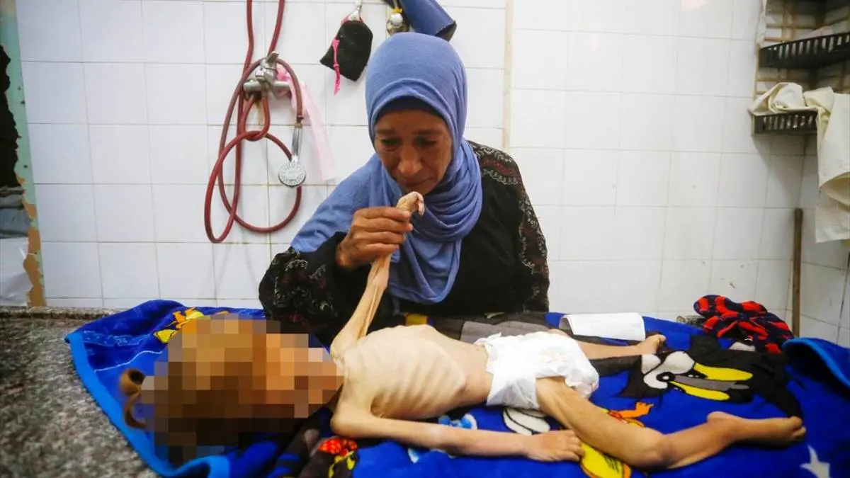 عکس/ مرگ کودک فلسطینی بر اثر سوءتغذیه در غزه