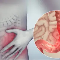 توضیحی کامل درباره سندروم روده تحریک پذیر