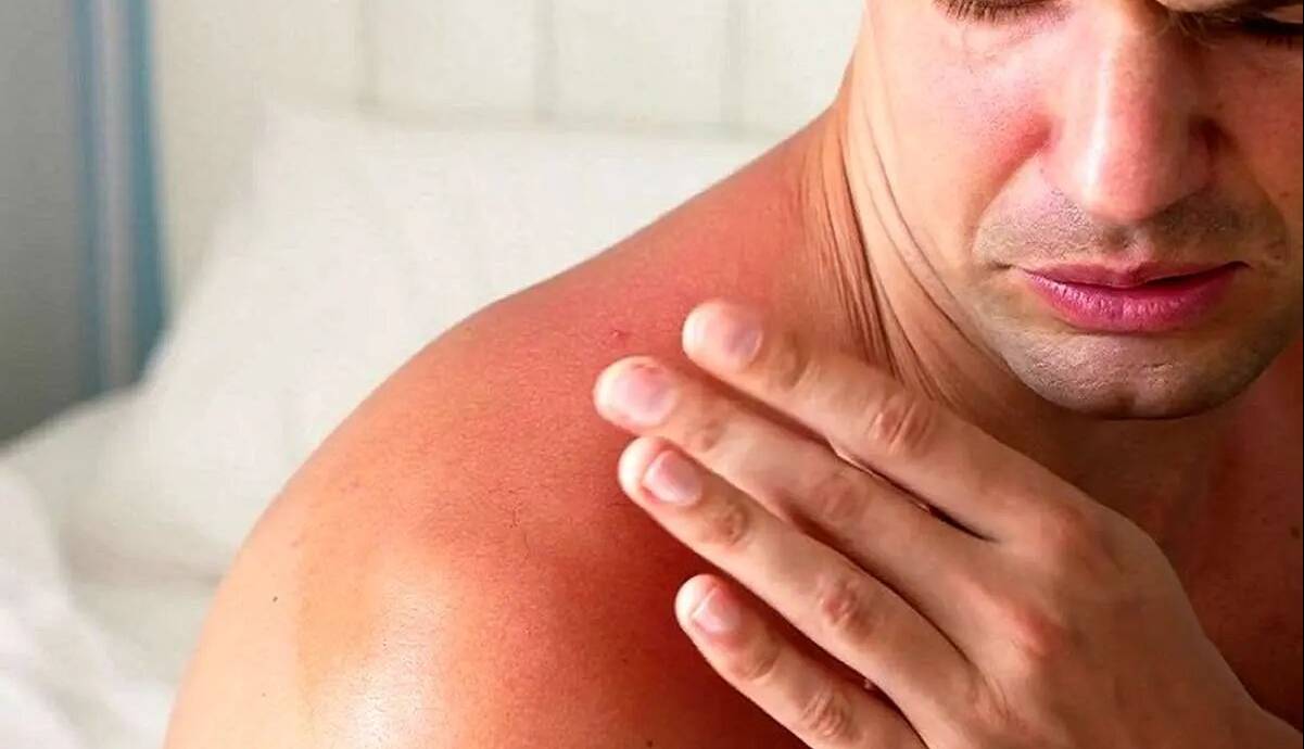 هشدار؛ مراقب سوختگی‌های پنهان آفتاب باشید