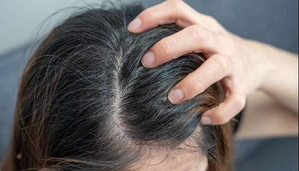 اگزمای پوست سر چیست و چطور درمان می‌شود؟