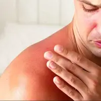 هشدار؛ مراقب سوختگی‌های پنهان آفتاب باشید