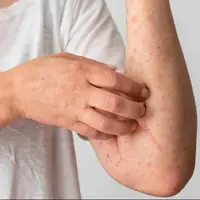 در مواجهه با اشعه فرابنفش چه کنیم؟