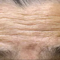 سازوکار چروک شدن پوست با افزایش سن کشف شد