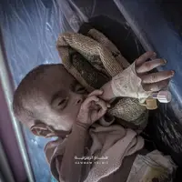 عکس/ مرگ تدریجی و دردناک نوزاد ۴ ماهه فلسطینی در غزه   