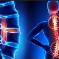 تنگی کانال می‌تواند بی علامت باشد!