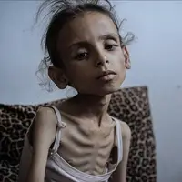 آمار سه رقمی شهدای غزه بر اثر قحطی و سوءتغذیه
