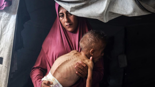کودک ۱۰ ساله فلسطینی، هم‌وزن نوزاد ۱۲ ماهه!
