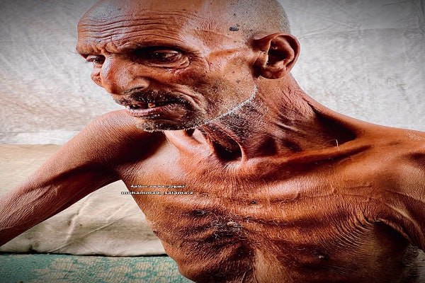 عکس/ تصاویری هولناک از تاثیرات گرسنگی بر موذن مسجد صحابه در جنوب غزه   