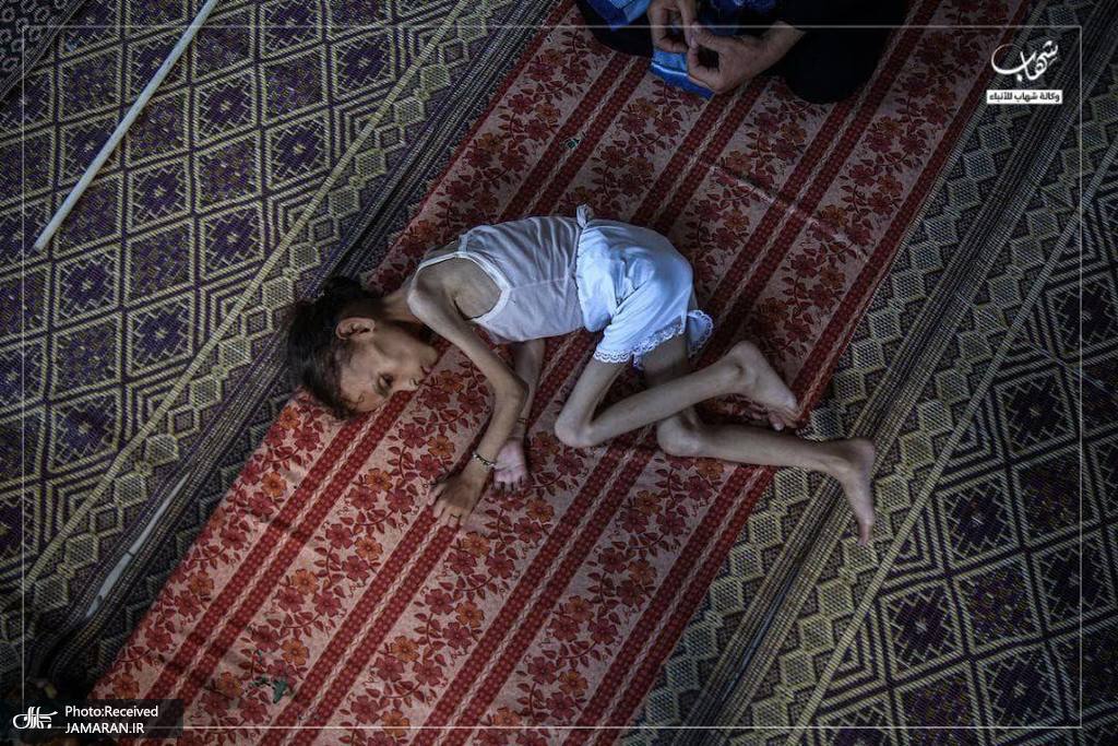 عکس/ تصاویر دردناک از تاثیر سوء تغذیه بر دختر فلسطینی