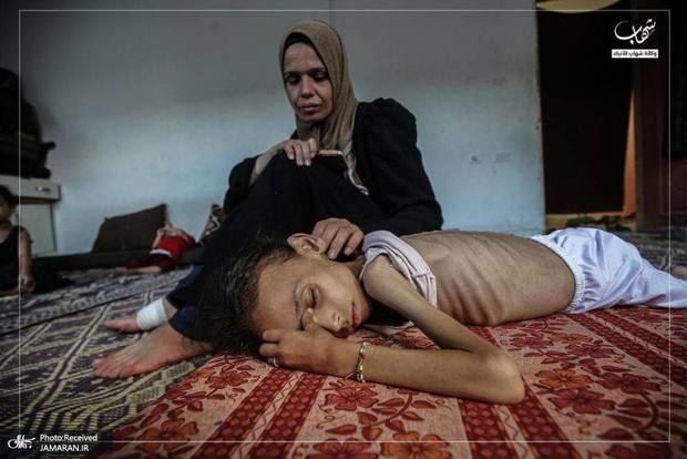 عکس/ تصاویر دردناک از تاثیر سوء تغذیه بر دختر فلسطینی
