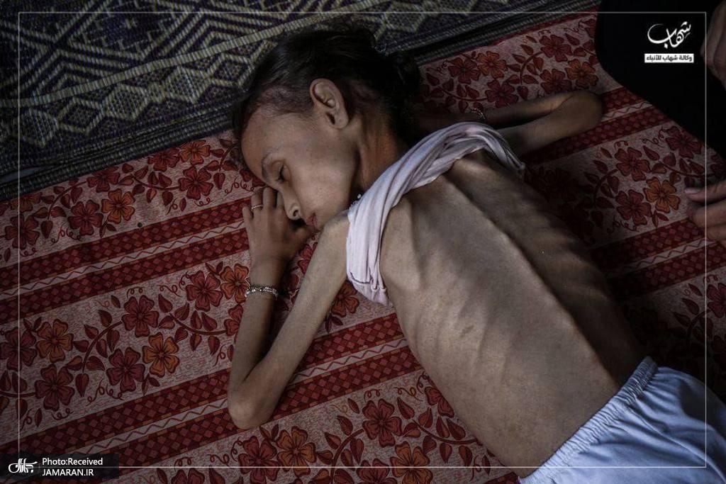 عکس/ تصاویر دردناک از تاثیر سوء تغذیه بر دختر فلسطینی
