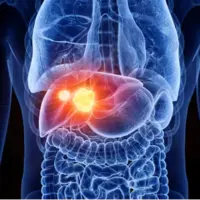 یکی از مرگبارترین سرطان‌های دنیا با سه راهکار ساده قابل پیشگیری است