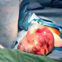 نجات جان مادر ۱۹ ساله با تومور بدخیم تخمدان در بیمارستان شریعتی بندرعباس