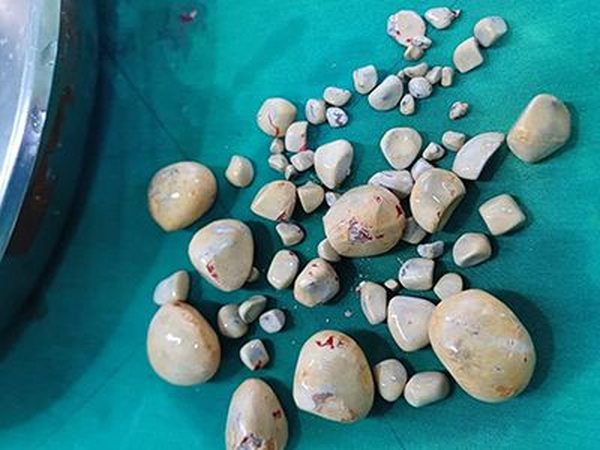 ۶۷ سنگ از مثانه بیمار ۷۰ ساله بوشهری خارج شد