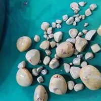 ۶۷ سنگ از مثانه بیمار ۷۰ ساله بوشهری خارج شد