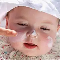 آفتاب سوختگی در کودکی، خطر ابتلا به سرطان پوست را افزایش می‌دهد