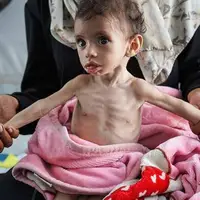 سازمان ملل: سوء تغذیه حاد در میان کودکان غزه به بالاترین سطح خود رسیده است