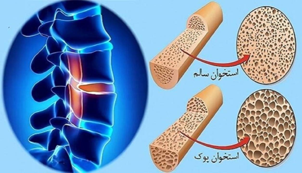 پوکی استخوان از دهه چهارم زندگی شروع میشود