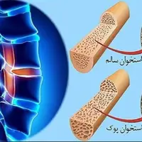 پوکی استخوان از دهه چهارم زندگی شروع می‌شود